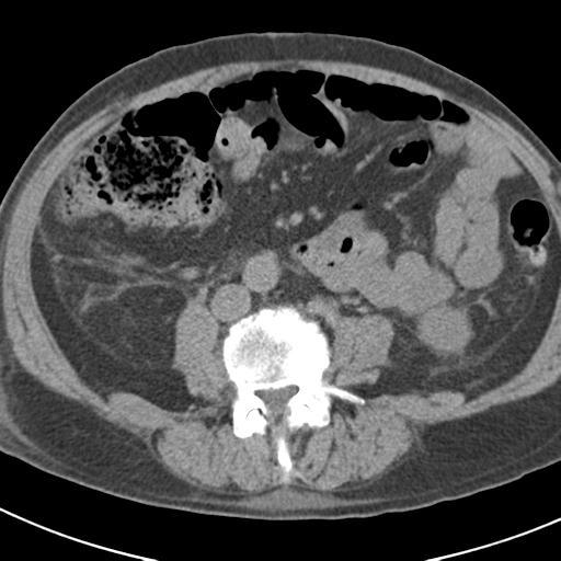 File:Acute pancreatitis and walled-off necrosis (Radiopaedia 29888-30403 Axial non-contrast 42).jpg