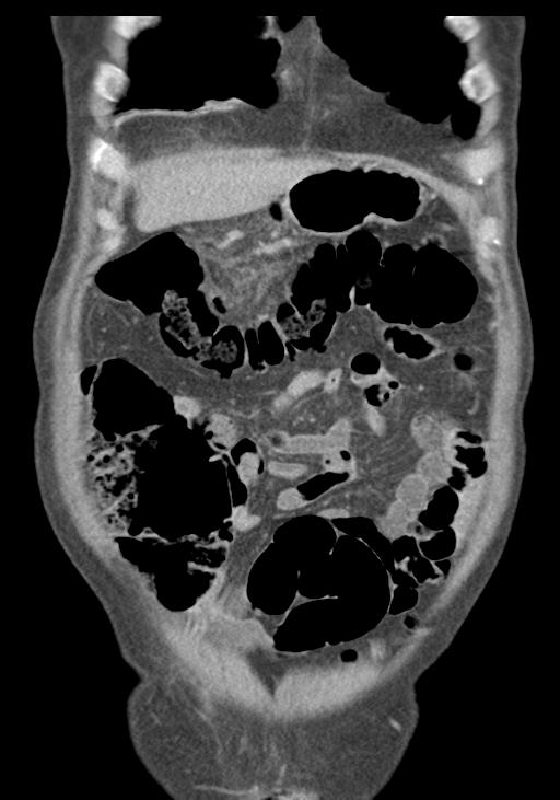 Acute pancreatitis and walled-off necrosis (Radiopaedia 29888-30403 E 14).jpg