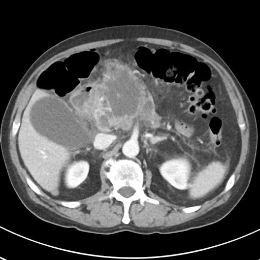 File:Acute pancreatitis and walled-off necrosis (Radiopaedia 29888-30404 Axial C+ portal venous phase 28).jpg