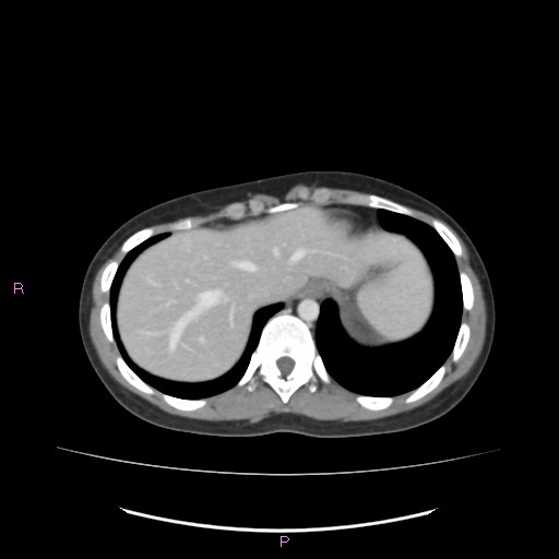 Acute pancreatitis secondary to stone at minor papilla and pancreatic divisum (Radiopaedia 76570-88333 Axial C+ portal venous phase 12).jpg