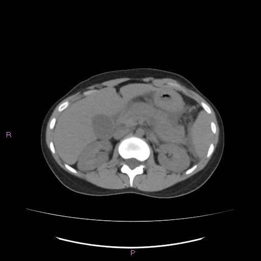 Acute pancreatitis secondary to stone at minor papilla and pancreatic divisum (Radiopaedia 76570-88333 Axial non-contrast 26).jpg