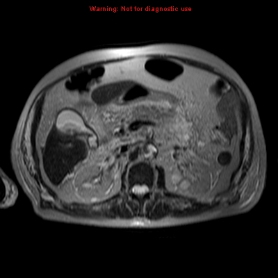 File:Acute pancreatitis with incidental pancreatic lipoma (Radiopaedia 10190-10732 Axial T2 9).jpg