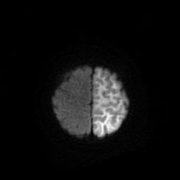 File:Acute phase of hemiconvulsion-hemiplegia epilepsy syndrome (Radiopaedia 29309-29745 Axial DWI 20).jpg
