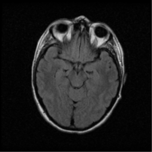 File:Acute pontine infarct from vertebral artery dissection (Radiopaedia 34111-35370 Axial FLAIR 8).png