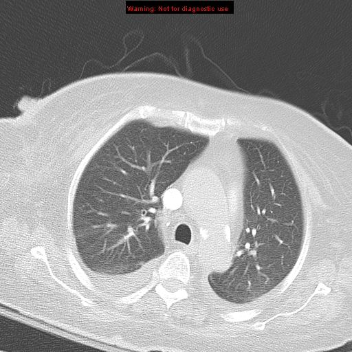 File:Acute pulmonary embolism (Radiopaedia 13286-13289 B 15).jpg