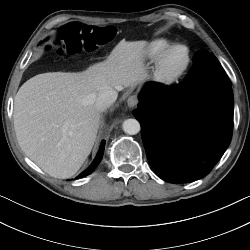 Acute renal infarction - rim capsular enhancement (Radiopaedia 59833-67270 Axial C+ portal venous phase 14).jpg