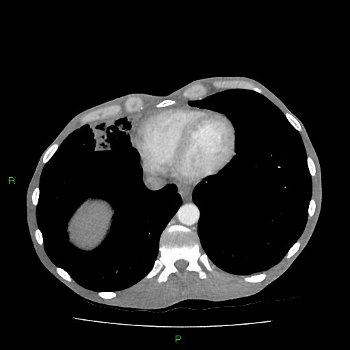File:Acute right lung abscess (Radiopaedia 34806-36258 Axial C+ arterial phase 146).jpg