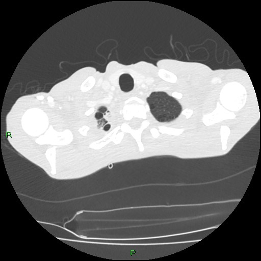 File:Acute right lung abscess (Radiopaedia 34806-36258 Axial lung window 10).jpg
