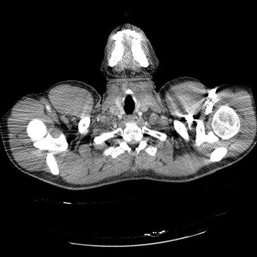 File:Acute segmental pulmonary emboli and pulmonary infarction (Radiopaedia 62264-70444 Axial C+ CTPA 7).jpg