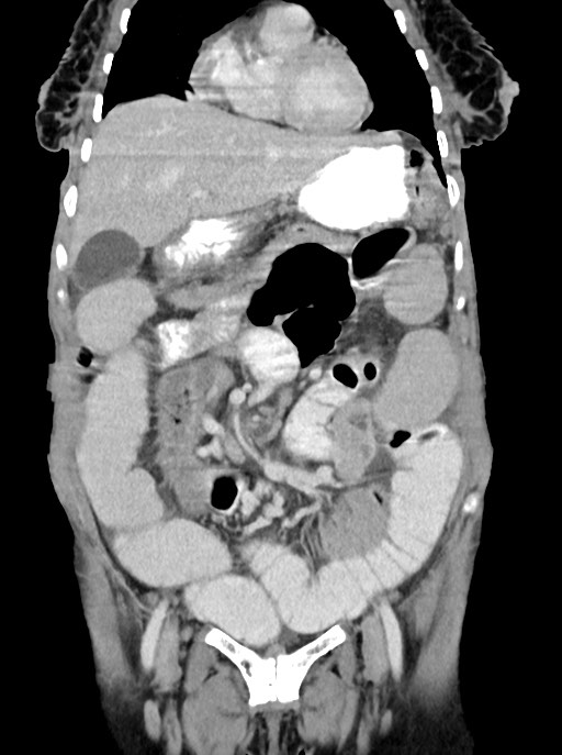 Acute small bowel (ileal) volvulus (Radiopaedia 71740-82139 Coronal C+ portal venous phase 39).jpg