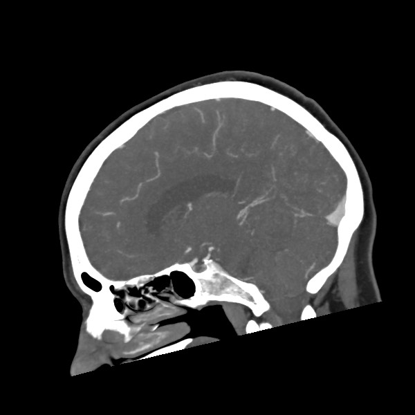 Acute subarachnoid hemorrhage and accessory anterior cerebral artery (Radiopaedia 69231-79009 Sagittal C+ arterial phase 41).jpg