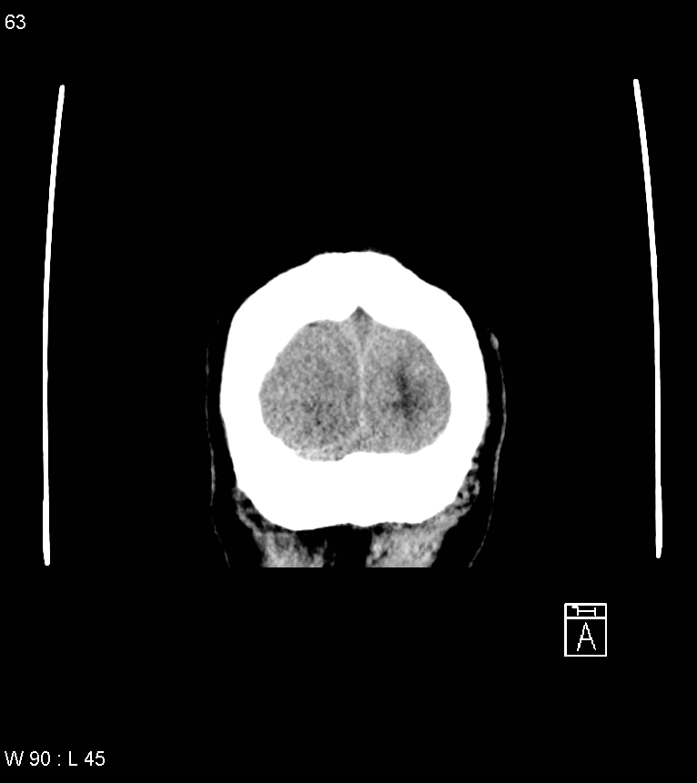 Acute subdural hematoma with myelofibrosis (Radiopaedia 52582-58494 Coronal non-contrast 54).jpg