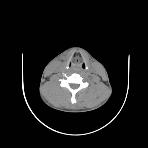 File:Acute submandibular sialadenitis secondary to ductal stone (Radiopaedia 27999-28267 Axial non-contrast 22).jpg