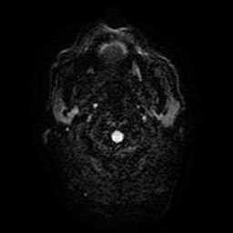 File:Acute superior cerebellar artery territory infarct (Radiopaedia 84104-99358 Axial DWI 32).jpg