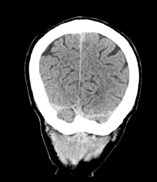 Acute superior cerebellar artery territory infarct (Radiopaedia 84104-99359 Coronal non-contrast 74).jpg