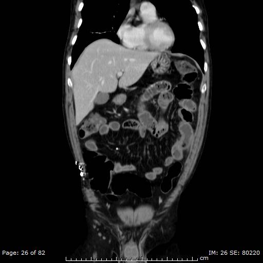 Acute superior mesenteric artery occlusion (Radiopaedia 43636-47060 Coronal C+ portal venous phase 11).jpg