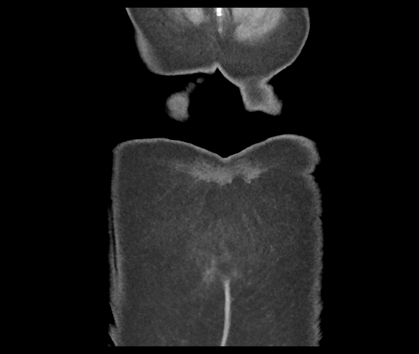 Acute superior mesenteric artery occlusion (Radiopaedia 43926-47418 Coronal C+ portal venous phase 52).png