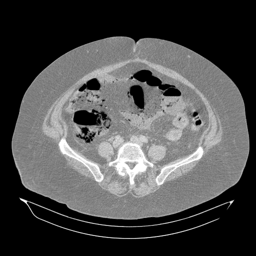 Acute superior mesenteric artery occlusion (Radiopaedia 51288-56960 Axial lung window 47).jpg