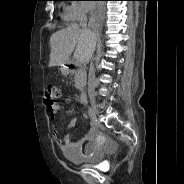 Acute tubular necrosis (Radiopaedia 28077-28334 Sagittal non-contrast 41).jpg