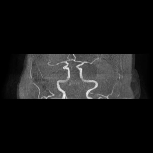 Acute vertebrobasilar ischemic infarction (Radiopaedia 25220-25474 Axial MRA 9).jpg