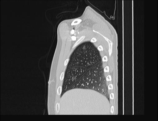 File:Addison disease (Radiopaedia 49318-54412 Sagittal lung window 55).jpg