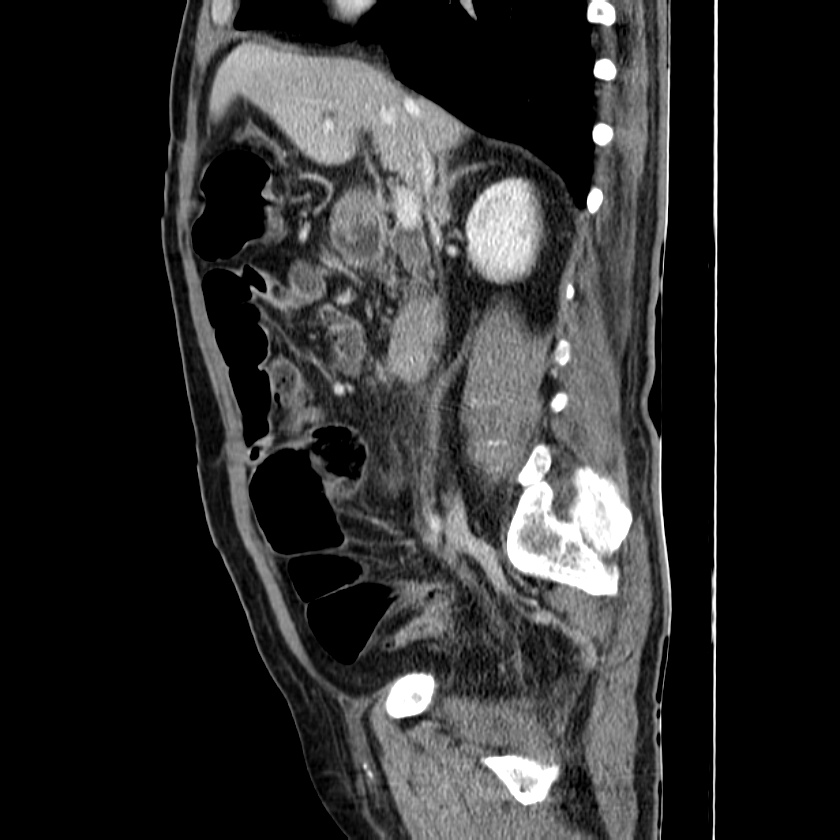 Adenocarcinoma of colon with entero-colic fistula (Radiopaedia 22832-22852 Sagittal C+ portal venous phase 26).jpg