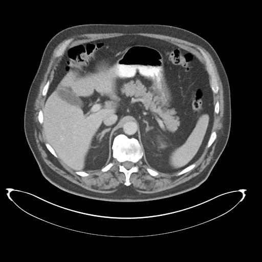 Adenocarcioma of rectum- T1 lesion (Radiopaedia 36921-38547 Axial C+ portal venous phase 25).png