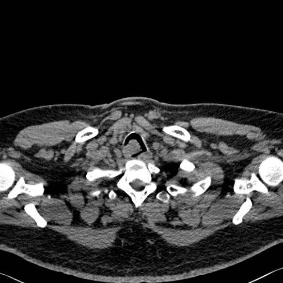File:Adenoid cystic carcinoma of the trachea (Radiopaedia 49042-54137 Axial non-contrast 18).jpg
