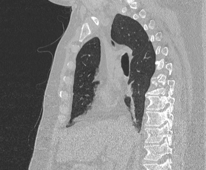 Adenoid cystic carcinoma of the trachea (Radiopaedia 49042-54137 Sagittal lung window 206).jpg