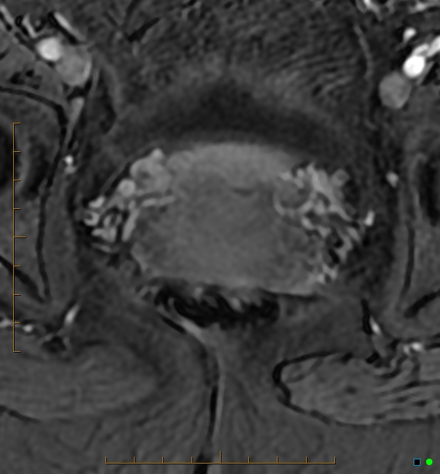 Adenomyosis uterus with hematometra (Radiopaedia 45779-50011 Axial T1 C+ fat sat 48).jpg