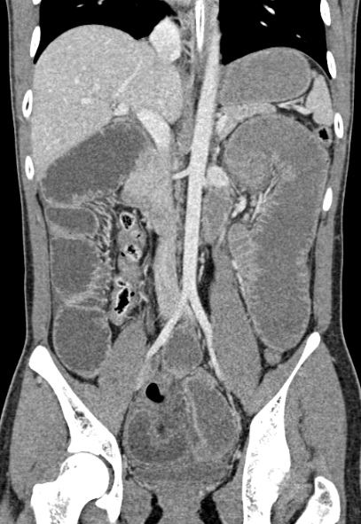 Adhesional small bowel obstruction (Radiopaedia 52107-57980 Coronal C+ portal venous phase 44).jpg