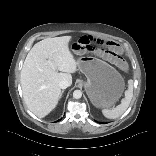 File:Adhesions within abdominal wall hernia (Radiopaedia 58283-65394 Axial C+ portal venous phase 19).png