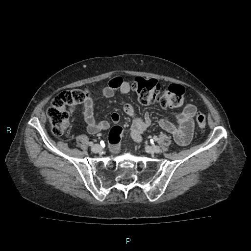File:Adrenal collision tumor (ACT) (Radiopaedia 48462-53379 Axial C+ delayed 49).jpg
