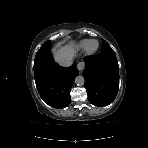 File:Adrenal collision tumor (ACT) (Radiopaedia 48462-53379 Axial non-contrast 5).jpg