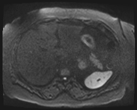 Adrenal cortical carcinoma (Radiopaedia 64017-72770 Axial DWI 93).jpg