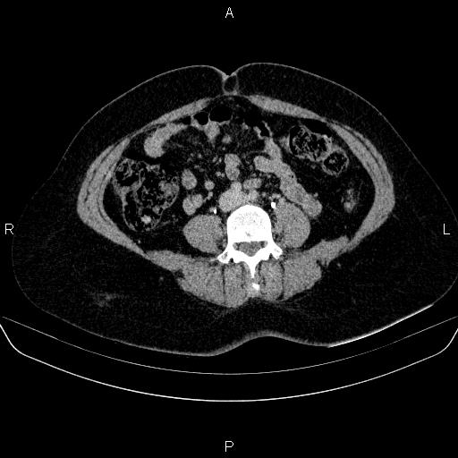 Adrenal cortical carcinoma (Radiopaedia 84882-100379 Axial C+ delayed 55).jpg