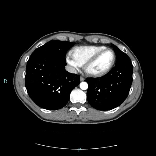 Adrenal cystic lymphangioma (Radiopaedia 83161-97534 Axial C+ arterial phase 6).jpg