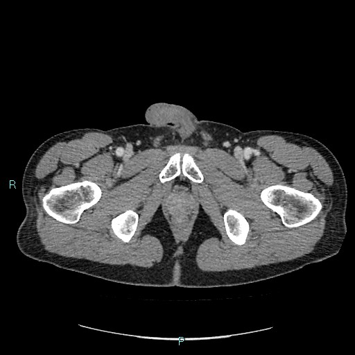 Adrenal cystic lymphangioma (Radiopaedia 83161-97534 Axial C+ portal venous phase 103).jpg