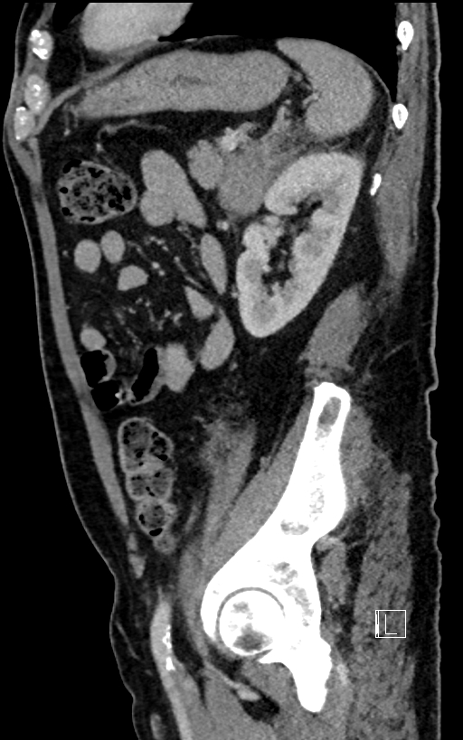 Adrenal lymphoma (Radiopaedia 73730-84529 Sagittal C+ portal venous phase 81).jpg