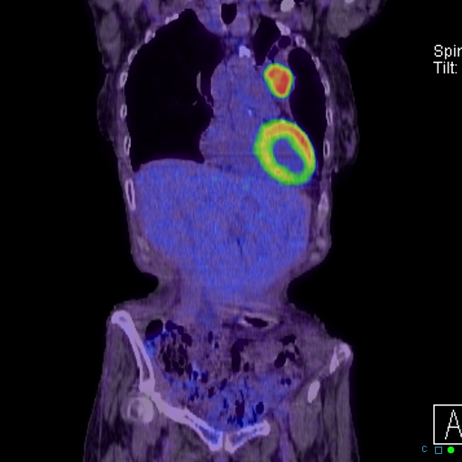 File:Adrenal metastasis from small cell lung cancer (Radiopaedia 19133-19109 Coronal 6).jpg