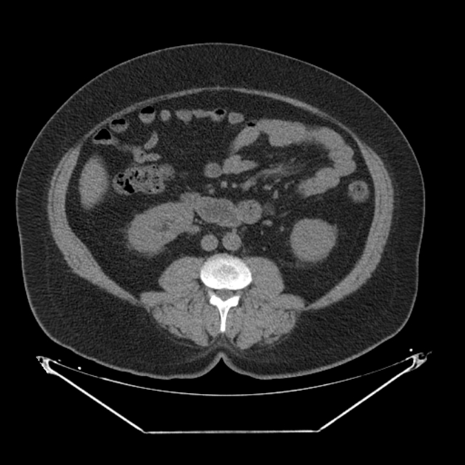 Adrenal myelolipoma (Radiopaedia 26278-26407 Axial non-contrast 36).jpg
