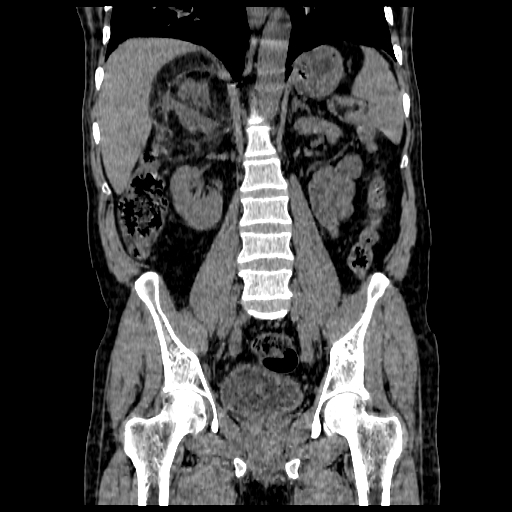 File:Adrenal myelolipoma (Radiopaedia 41843-44834 Coronal non-contrast 9).jpg