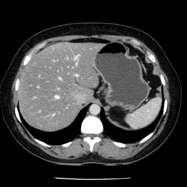 File:Adrenal myelolipoma (Radiopaedia 43401-46759 Axial C+ portal venous phase 16).jpg