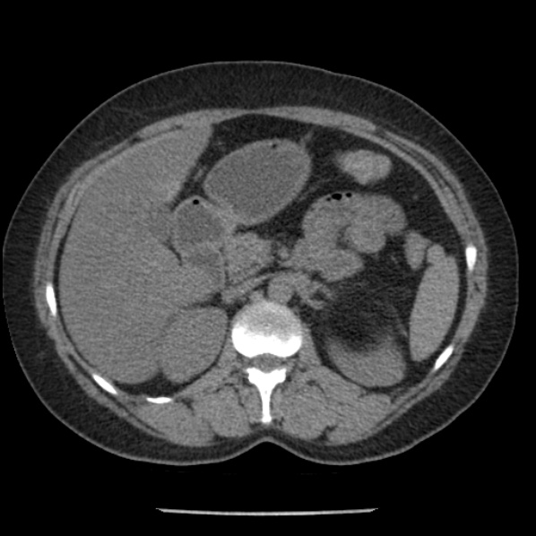 Adrenal myelolipoma (Radiopaedia 43401-46759 Axial non-contrast 31).jpg