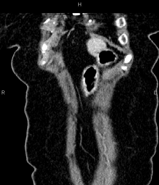 File:Adrenal myelolipoma (Radiopaedia 82742-96986 Coronal renal cortical phase 12).jpg