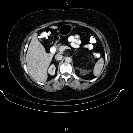 Adrenal myelolipoma (Radiopaedia 84319-99617 Axial renal cortical phase 40).jpg