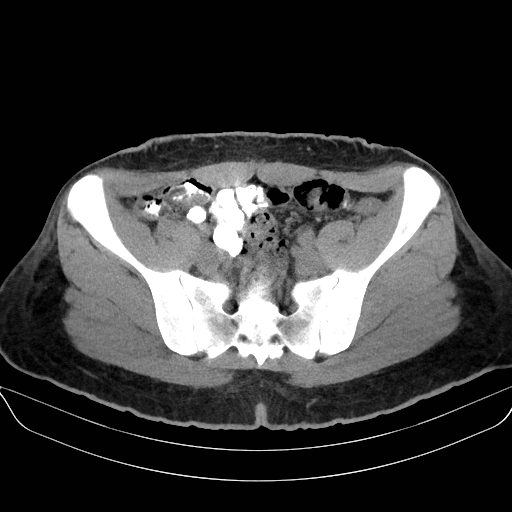 File:Adrenal myelolipoma - bilateral (Radiopaedia 74805-85810 Axial non-contrast 63).jpg