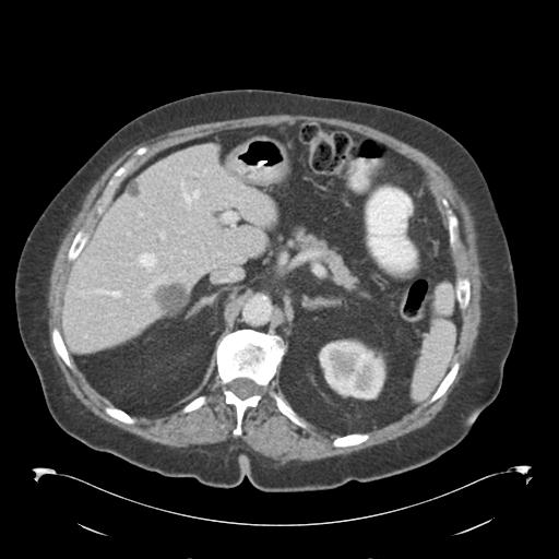 Adult ileal intussusception with secondary obstruction (Radiopaedia 30395-31051 Axial C+ portal venous phase 20).jpg