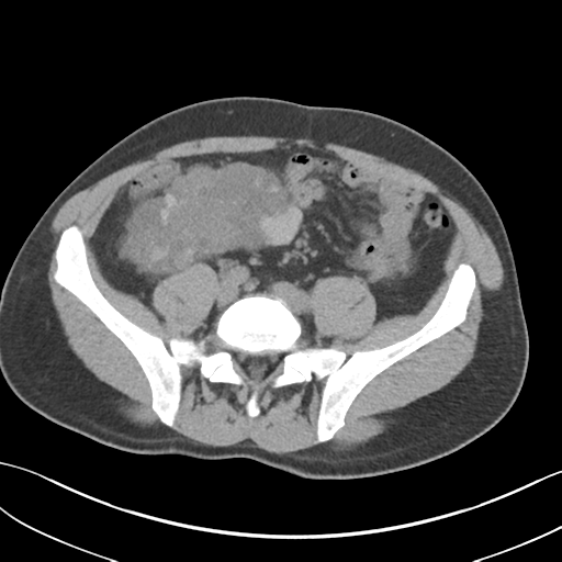 File:Adult polycystic kidney disease (Radiopaedia 47866-52626 Axial non-contrast 56).png