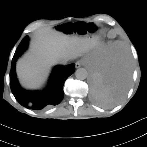 Advanced metastatic lung cancer (Radiopaedia 48910-53954 Axial non-contrast 53).png